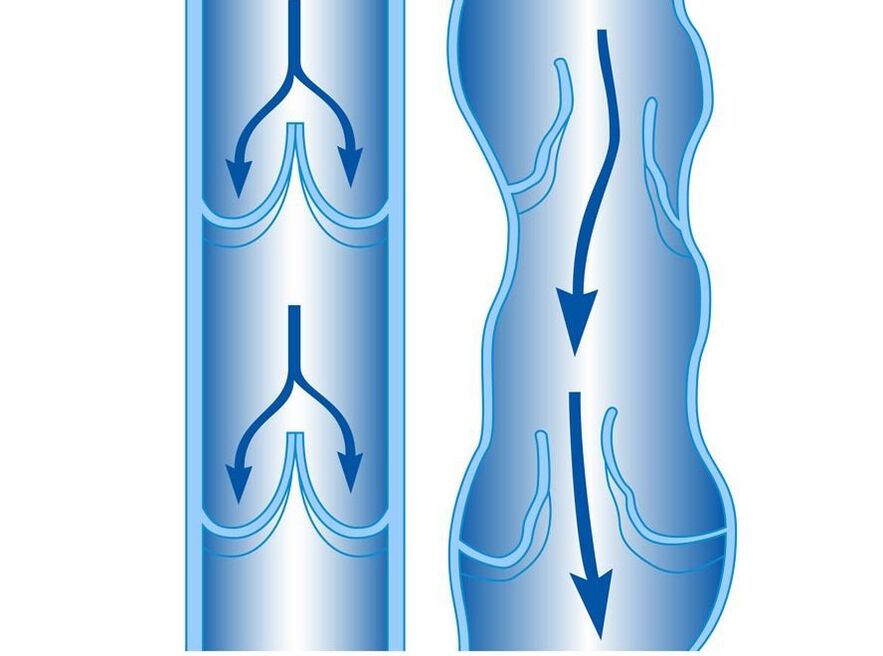 venă sănătoasă și varicoasă