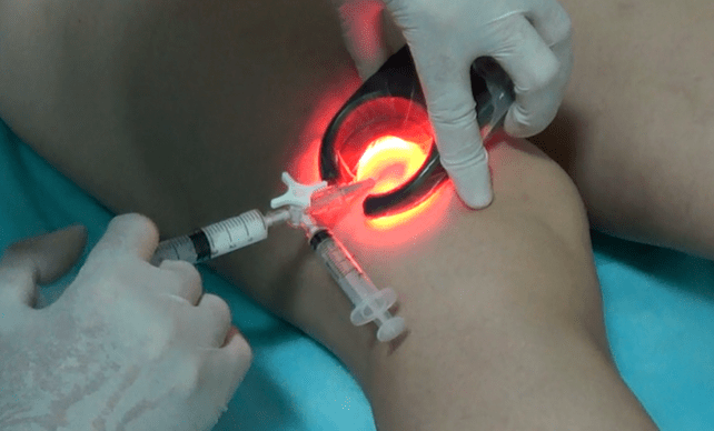Scleroterapia este o metodă eficientă de tratare a venelor varicoase de pe picioare